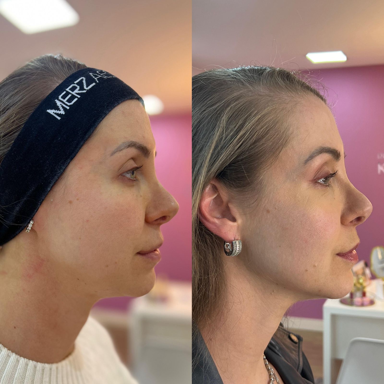 Harmonização Facial